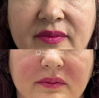 Antes e depois — preenchimento bigode chinês